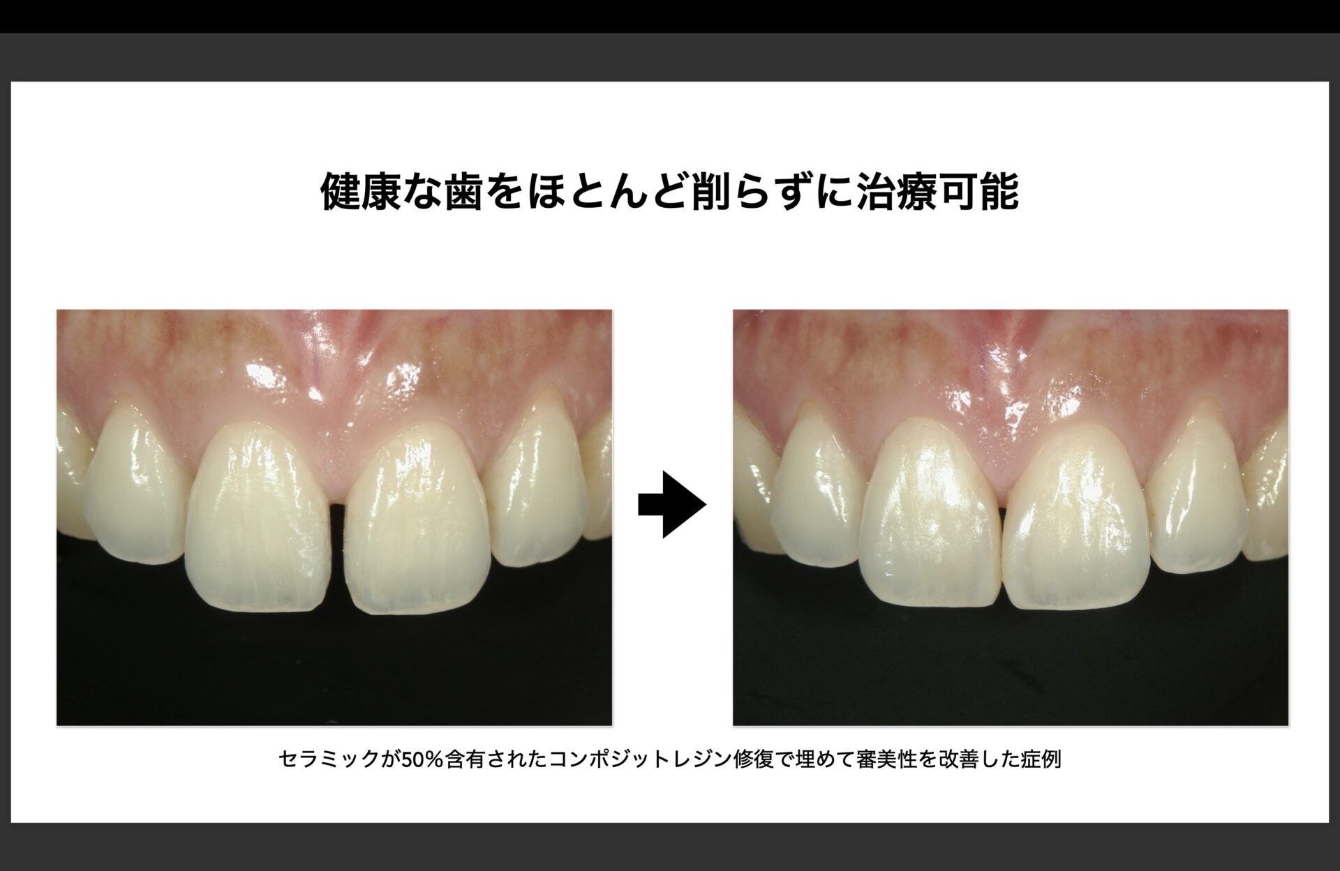 できるだけ削らない虫歯治療（詰める編） - 名取市箱塚の歯科医院